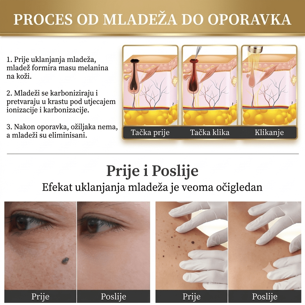 Plasma Pen Aparat za Uklanjanje Mladeža, Bradavica i Pjegica - Zoro
